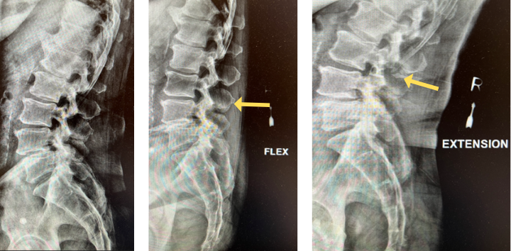 This shows the lumbar spine in motion. Notice the L4 and L5 level changes with flexion and extension. Notice the L2 and L3 levels do not have that type of motion. This is instability