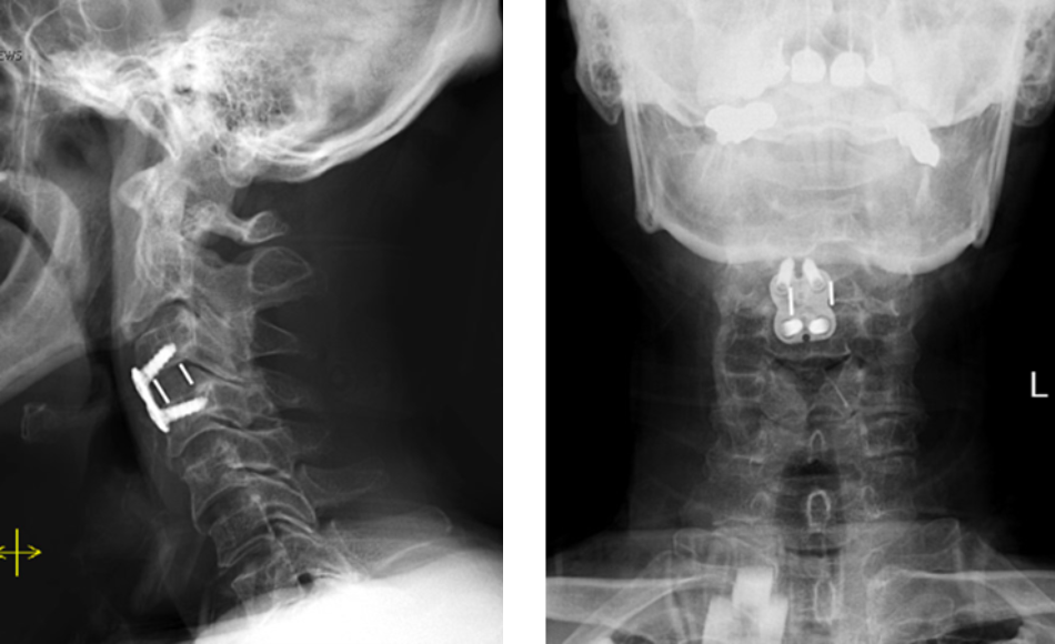 Lateral and AP cervical spine x-rays s/p ACDF