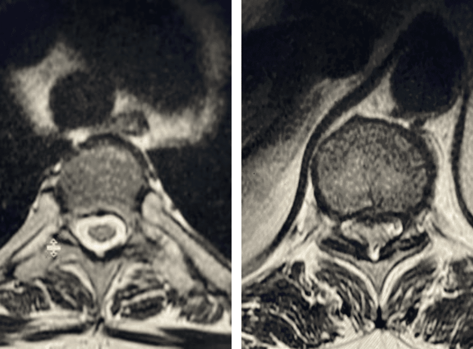 fig 2 thoracic