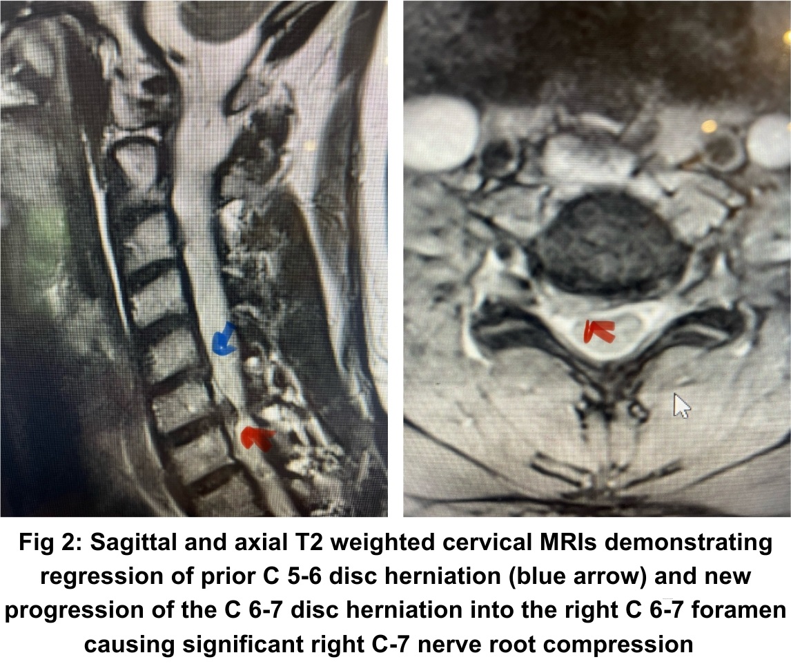 NSPC Brain & Spine Surgery Fig 2 NSPC Brain & Spine Surgery Fig 2